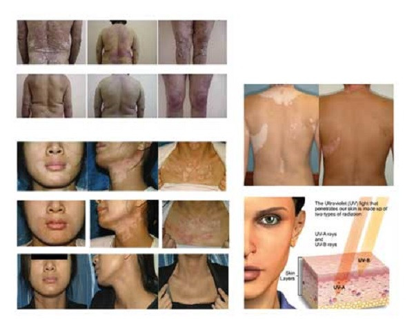 دستگاه نوردرمانی UVB تک لامپ BM1 با پایه